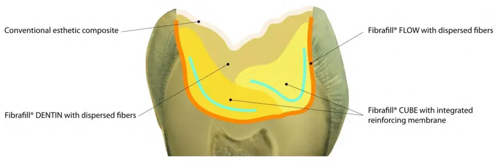 Figure 6: Schematic representation of utilization of Fibrafill® system in the case of large Class II restoration.