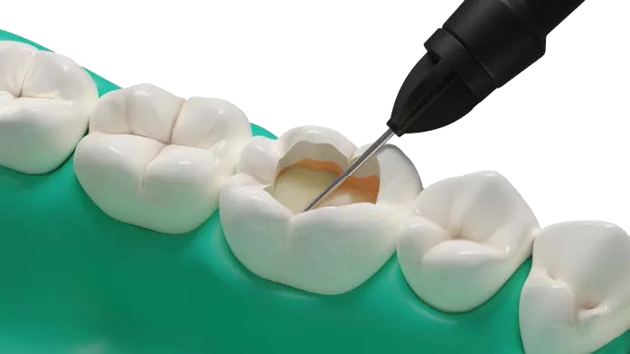 Fibrafill® FLOW cavity restoration