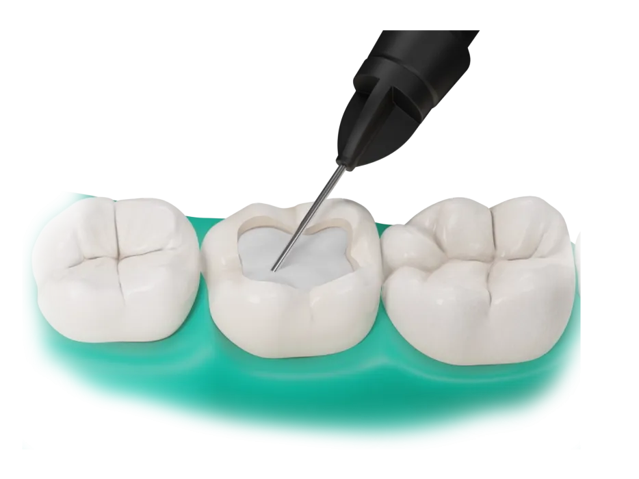 Fibrafill FLOW restoration visualisation