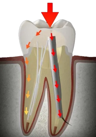 Dentapreg® PINPost distributes occlusal forces for durable root canal restorations