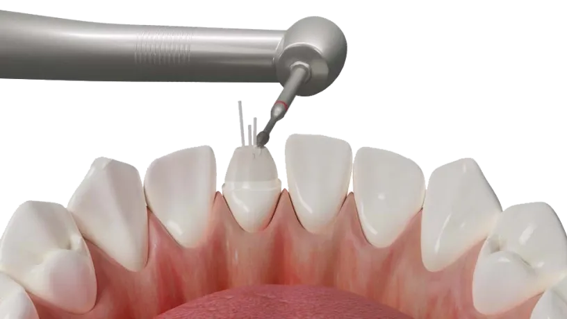 Dentapreg® PINPost application for strong and aesthetic dental restorations